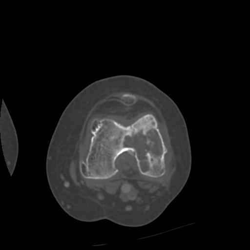 Chondrosarcoma - femur (Radiopaedia 64187-72954 Axial bone window 44).jpg