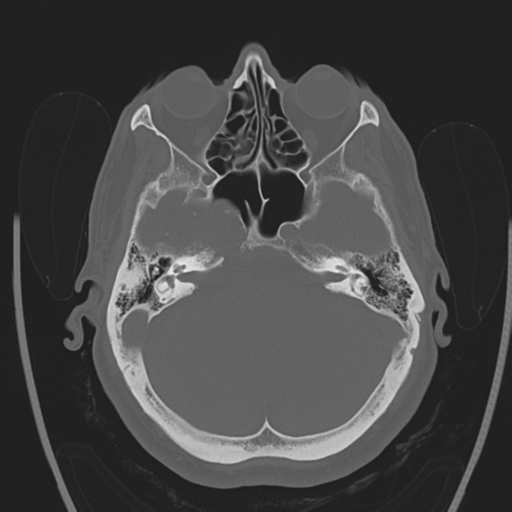 File:Chondrosarcoma of skull base- grade II (Radiopaedia 40948-43653 Axial bone window 11).png