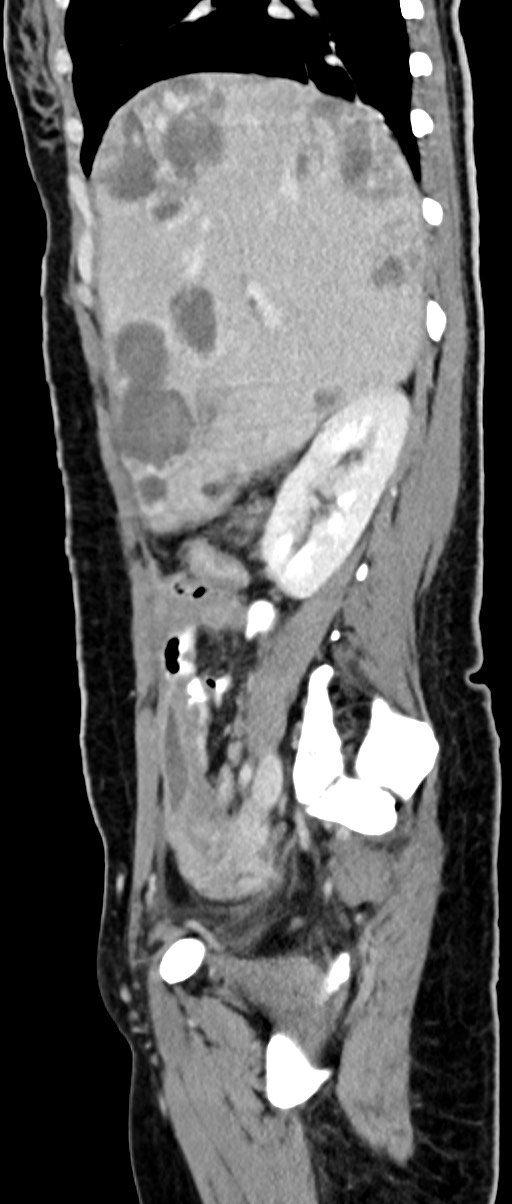 Choriocarcinoma liver metastases (Radiopaedia 74768-85766 C 121).jpg