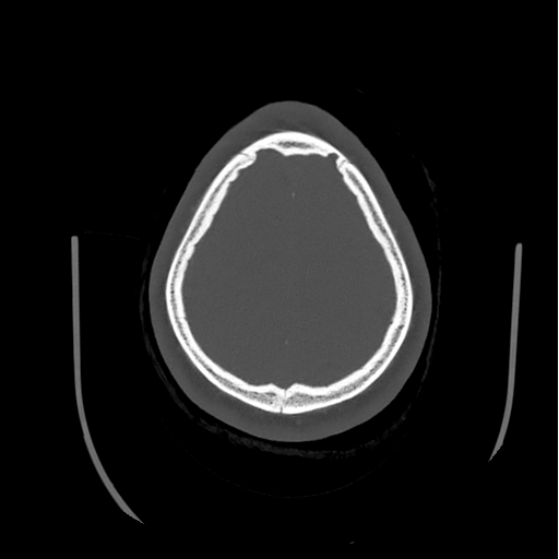 Choroid plexus papilloma extending into the cerebellopontine angle cistern (Radiopaedia 85941-101833 Axial bone window 80).png