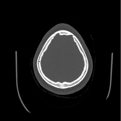 Choroid plexus papilloma extending into the cerebellopontine angle cistern (Radiopaedia 85941-101833 Axial bone window 81).png