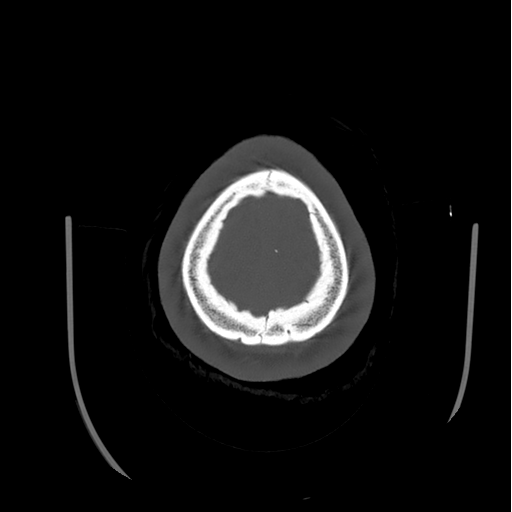 Choroid plexus papilloma extending into the cerebellopontine angle cistern (Radiopaedia 85941-101833 Axial bone window 86).png