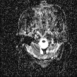 File:Choroid plexus xanthogranuloma - unilateral (Radiopaedia 85632-101393 Axial ADC 1).jpg
