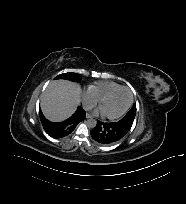 Chromophobe renal cell carcinoma (Radiopaedia 84239-99519 Axial non-contrast 20).jpg