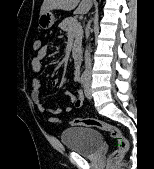 Chromophobe renal cell carcinoma (Radiopaedia 84286-99573 C 92).jpg