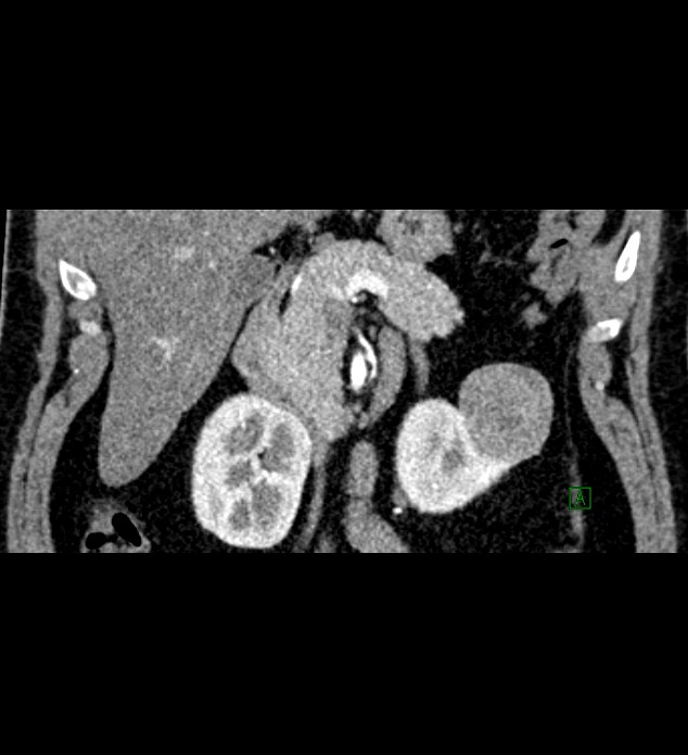 Chromophobe renal cell carcinoma (Radiopaedia 84286-99573 E 22).jpg