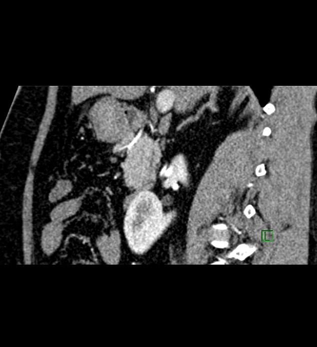 Chromophobe renal cell carcinoma (Radiopaedia 84286-99573 F 102).jpg