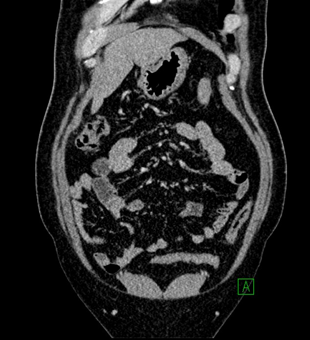 Chromophobe renal cell carcinoma (Radiopaedia 84286-99573 H 41).jpg