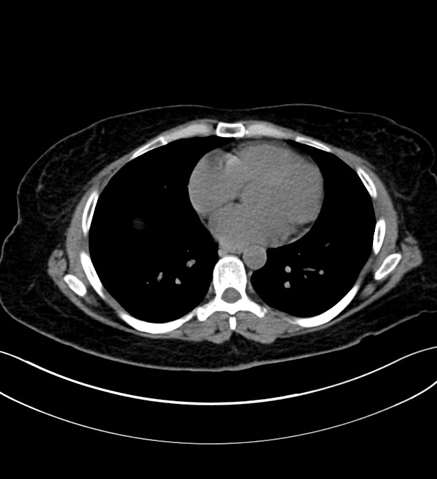 Chromophobe renal cell carcinoma (Radiopaedia 84290-99582 Axial non-contrast 5).jpg