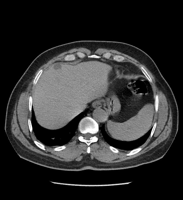 Chromophobe renal cell carcinoma (Radiopaedia 86879-103083 Axial non-contrast 1).jpg