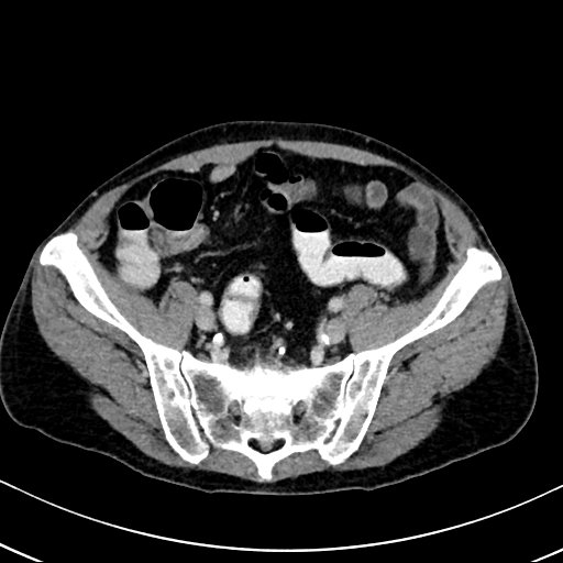 Chronic appendicitis complicated by appendicular abscess, pylephlebitis and liver abscess (Radiopaedia 54483-60700 B 113).jpg