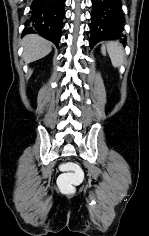 Chronic appendicitis complicated by appendicular abscess, pylephlebitis and liver abscess (Radiopaedia 54483-60700 C 67).jpg