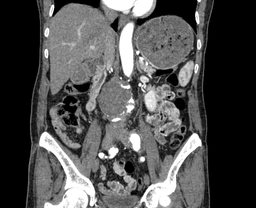 File:Chronic contained rupture of abdominal aortic aneurysm with extensive erosion of the vertebral bodies (Radiopaedia 55450-61901 D 37).jpg