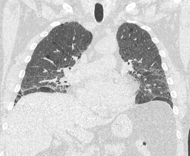 File:Chronic hypersensitivity pneumonitis (Radiopaedia 48107-52922 Coronal lung window 13).png