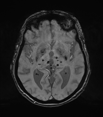 Chronic hypertensive encephalopathy (Radiopaedia 72844-83495 Axial SWI magnitude 40).png
