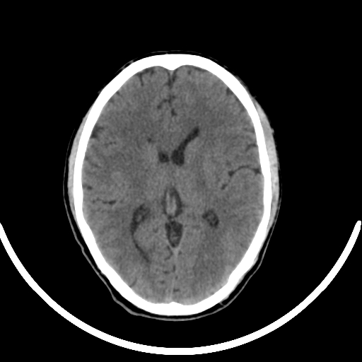 Chronic invasive fungal sinusitis with intraorbital and intracranial extension (Radiopaedia 56387-63046 Axial non-contrast 215).jpg