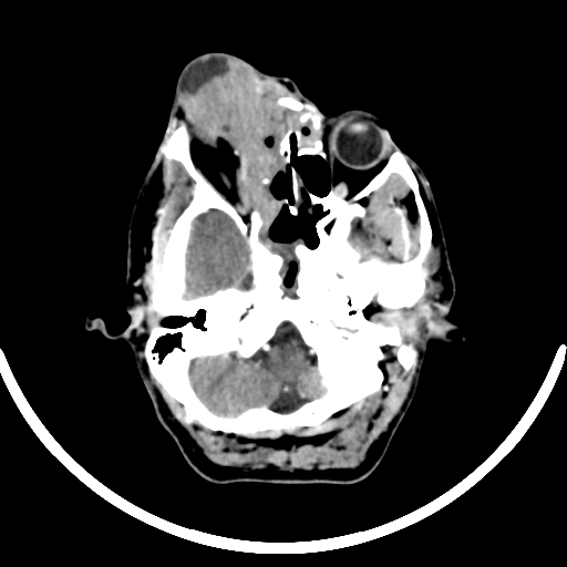 Chronic invasive fungal sinusitis with intraorbital and intracranial extension (Radiopaedia 56387-63046 B 88).jpg
