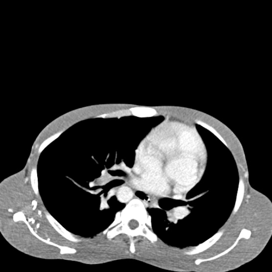 Chronic large bowel pseudo-obstruction (Radiopaedia 43181-46492 A 11).jpg