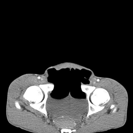 Chronic large bowel pseudo-obstruction (Radiopaedia 43181-46492 A 155).jpg