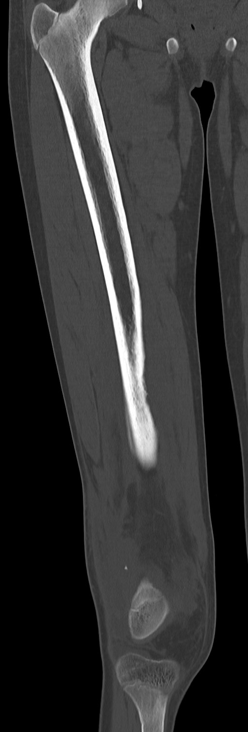 Chronic ostemyelitis of the femur with long sinus tract (Radiopaedia 74947-85982 Coronal bone window 36).jpg