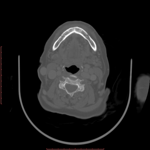 Chronic osteomyelitis - maxilla (Radiopaedia 23783-23927 Axial bone window 21).jpg
