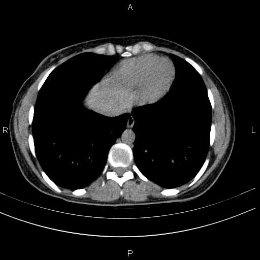 File:Chronic pancreatitis (Radiopaedia 64576-73450 Axial non-contrast 1).jpg