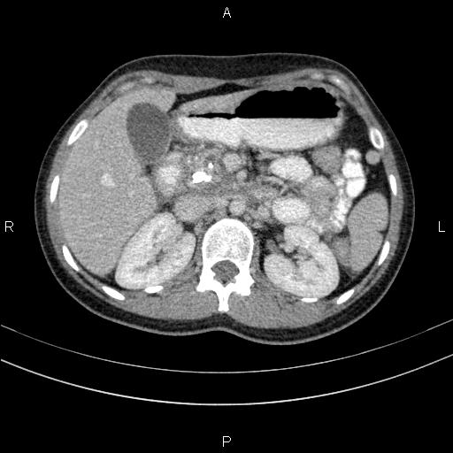 Chronic pancreatitis (Radiopaedia 64576-73450 C 50).jpg