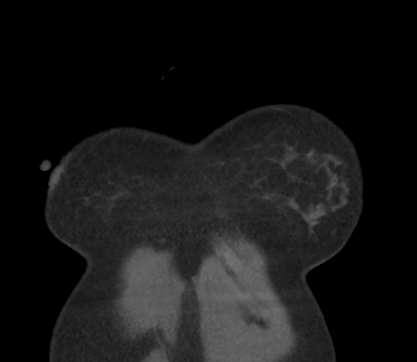 Chronic pulmonary embolus (Radiopaedia 39129-41341 Coronal C+ CTPA 8).png