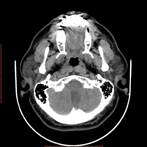Chronic submandibular sialolithiasis (Radiopaedia 69817-79814 Axial non-contrast 36).jpg
