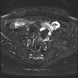 File:Class II Mullerian duct anomaly- unicornuate uterus with rudimentary horn and non-communicating cavity (Radiopaedia 39441-41755 Axial T2 fat sat 8).jpg