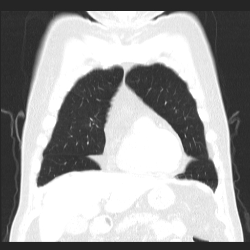 File:Classic complicated silicosis (Radiopaedia 49720-54961 Coronal lung window 14).jpg