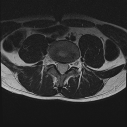 File:Clear cell meningoma - lumbar spine (Radiopaedia 60116-67690 Axial T2 13).png