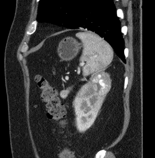 File:Clear cell renal cell carcinoma (Radiopaedia 61449-69393 D 11).jpg