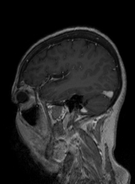 Clival meningioma (Radiopaedia 53278-59248 Sagittal T1 C+ 179).jpg