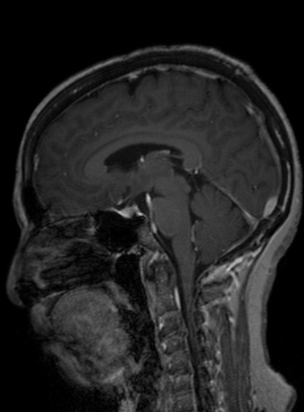Clival meningioma (Radiopaedia 53278-59248 Sagittal T1 C+ 252).jpg