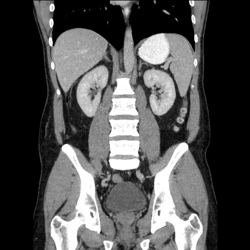 Closed-loop small bowel obstruction (Radiopaedia 73713-84509 C 78).jpg