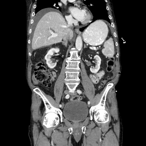 Closed loop small bowel obstruction - adhesive disease and hemorrhagic ischemia (Radiopaedia 86831-102990 B 72).jpg