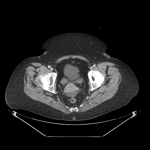 File:Closed loop small bowel obstruction - internal hernia (Radiopaedia 65402-74450 A 123).jpg