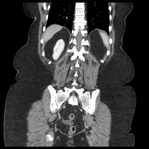 Closed loop small bowel obstruction - internal hernia (Radiopaedia 65402-74450 B 85).jpg
