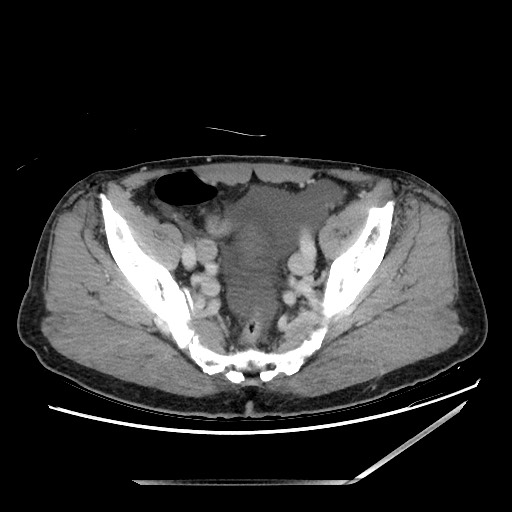 Closed loop small bowel obstruction - omental adhesion causing "internal hernia" (Radiopaedia 85129-100682 A 140).jpg