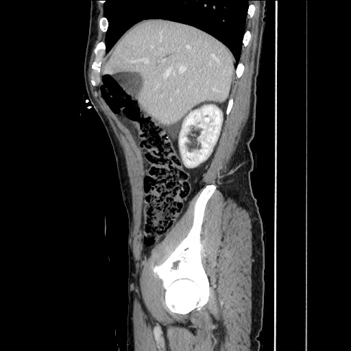 Closed loop small bowel obstruction - omental adhesion causing "internal hernia" (Radiopaedia 85129-100682 C 52).jpg