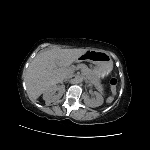 File:Closed loop small bowel obstruction due to adhesive band, with intramural hemorrhage and ischemia (Radiopaedia 83831-99017 Axial non-contrast 53).jpg