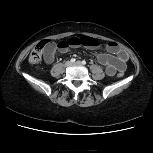 Closed loop small bowel obstruction due to adhesive bands - early and late images (Radiopaedia 83830-99015 A 106).jpg