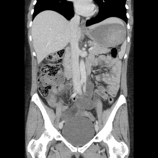 File:Closed loop small bowel obstruction due to trans-omental herniation (Radiopaedia 35593-37109 B 28).jpg