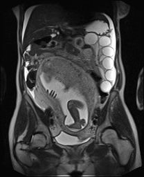 File:Closed loop small bowel obstruction in pregnancy (MRI) (Radiopaedia 87637-104031 Coronal T2 30).jpg