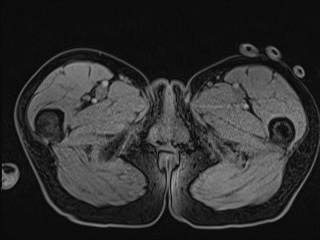 Closed loop small bowel obstruction in pregnancy (MRI) (Radiopaedia 87637-104031 G 42).jpg