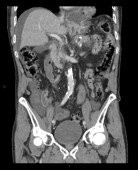 Closed loop small bowel obstruction with ischemia (Radiopaedia 84180-99456 B 35).jpg