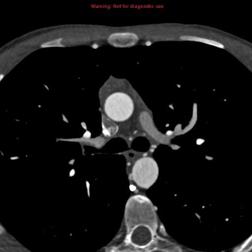 File:Coarctation of the aorta (Radiopaedia 12461-12697 A 159).jpg