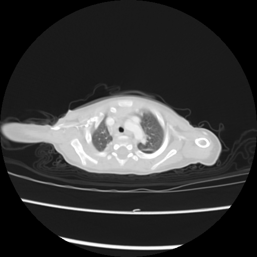 Coarctation of the aorta and patent ductus arteriosus (Radiopaedia 68033-77499 Axial lung window 5).jpg