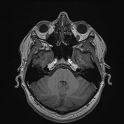 File:Cochlear incomplete partition type III associated with hypothalamic hamartoma (Radiopaedia 88756-105498 Axial T1 62).jpg